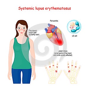 Systemic lupus erythematosus