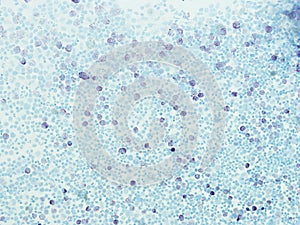 Systemic mastocytosis ( toluidine blue stain).