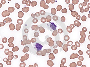 T-cell large granular lymphocytic leukemia.