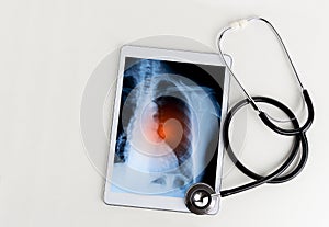 Tablet with an x-ray of a lung and a stethoscope