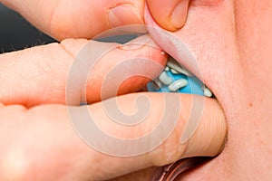Taking dental imprint