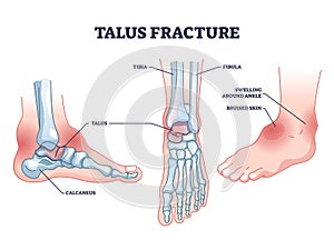 Talus fracture and broken leg with swelling ankle symptom outline diagram