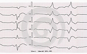 Tape ECG with acute period of myocardial infarction