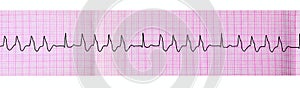 Tape ECG with group ventricular extrasystoles