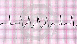 Tape ECG with group ventricular extrasystoles