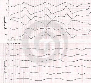 Tape ECG with idioventricular rhythm (dying heart)