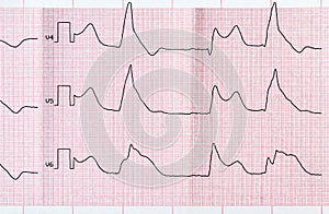 Tape ECG with macrofocal myocardial infarction and ventricular b