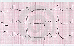Tape ECG with macrofocal myocardial infarction and ventricular p