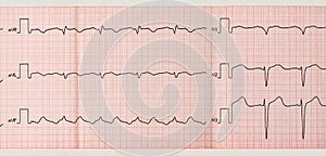 Tape ECG with paroxysm of atrial flutter