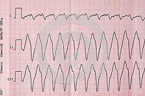 Tape ECG with paroxysm correct form of atrial flutter photo