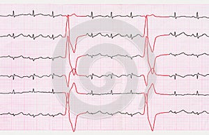 Tape ECG with ventricular premature beats (quadrigemini)