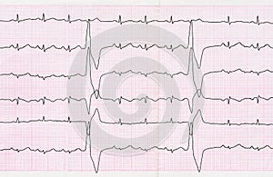 Tape ECG with ventricular premature beats (quadrigeminia)