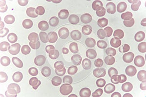 Target cells with abnormal red blood cells from anemia patient