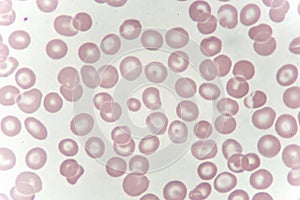 Target cells with abnormal red blood cells from anemia patient photo