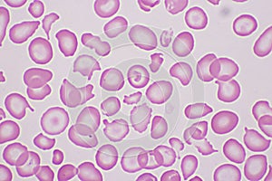 Target cells with abnormal red blood cells