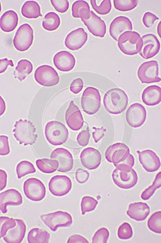 Target cells with abnormal red blood cells