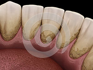 Tartar and bactrail tooth plaque, lower jaw. Medically accurate 3D illustration of human teeth treatment