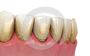 Tartar and bactrail tooth plaque, lower jaw. Medically accurate 3D illustration of human teeth treatment