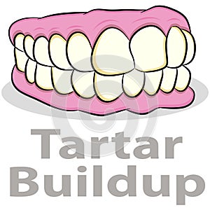 Tartar Buildup on Teeth