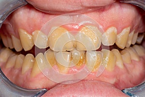Tartar close-up on the lower anterior incisors. Dental hygiene of teeth