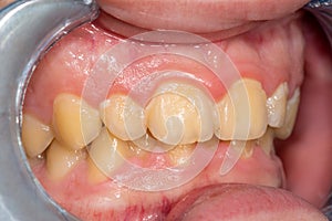 Tartar close-up on the lower anterior incisors. Dental hygiene of teeth