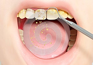 Tartar removal in human teeth by conventional periodontal therapy using dental tools