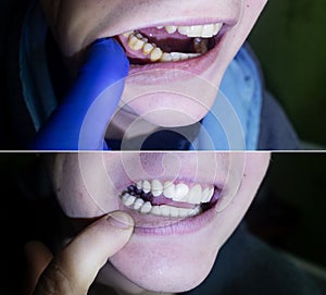 Tartar removal. Before and after the procedure for cleaning the tooth enamel from plaque and yellowness. Deposition of microbial