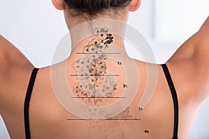 Tattoo Removal On Woman`s Back photo