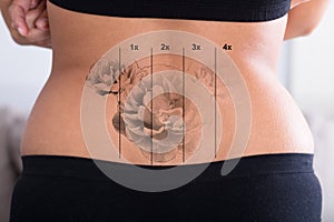 Tattoo Removal On Woman`s Hip