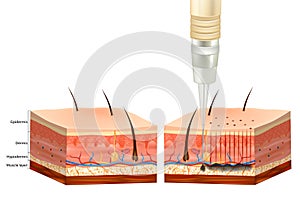 The Tattooing Process. Tattoo Pigment under skin of Epidermis and Dermis. photo