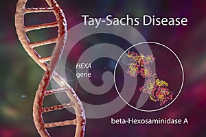 Tay-Sachs disease, 3D illustration