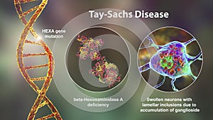 Tay-Sachs disease, 3D illustration