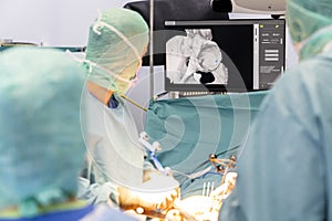 Team of doctor perform total hip arthroplasty replacement surgery in osteoarthritis patient inside the operating room. mako robot-