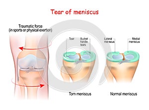 Tear of a meniscus. Torn meniscus