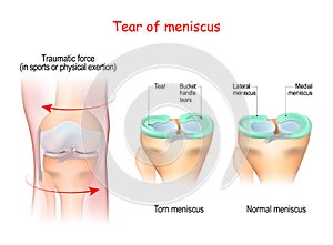 Tear of a meniscus. Torn meniscus photo