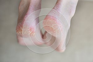 Close up cracked heels. Health problems with skin on feet