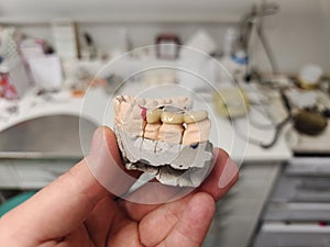 Technician dental is working with complete metal ceramic prosthesis dental.