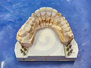 Technician workplace for placing fixed denture in mouth