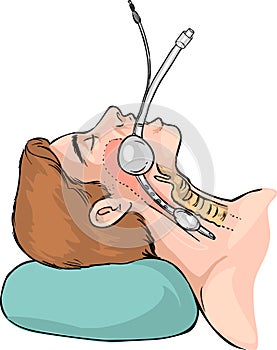Technique of tubal intubation photo