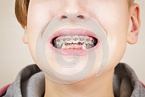 Teen with braces on his teeth.