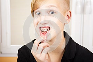 Teen with braces on his teeth.