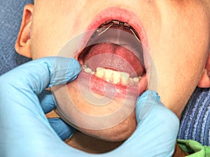 Teen with braces on his teeth. Macro shot of teeth with braces.