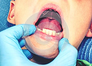 Teen with braces on his teeth. Macro shot of teeth with braces.