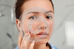 Teen girl applying acne healing patch indoors
