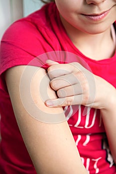 Teen girl showing mark of the tuberculosis vaccine BCG on the shoulder, close up view photo