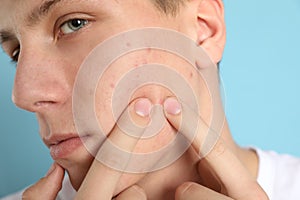 Teen guy with acne problem squeezing pimple on blue background, closeup