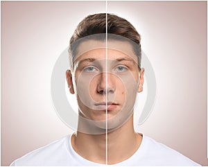 Teen guy with acne problem before and after treatment on light background, collage