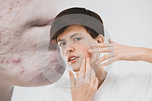 Teenage boy suffering from acnephobia examining face. Person with problem skin