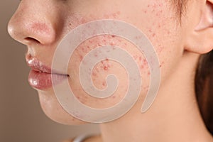 Teenage girl with acne problem on beige, closeup