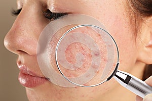 Teenage girl with acne problem visiting dermatologist. Skin under magnifying glass photo